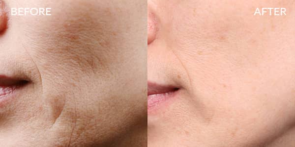 Potenza RF Microneedling for Wrinkles