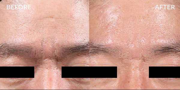 Potenza RF Microneedling for Wrinkles