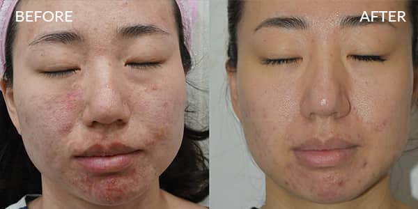 Potenza-RF-Microneedling-Acne and Acne Scars Before-and-after-13