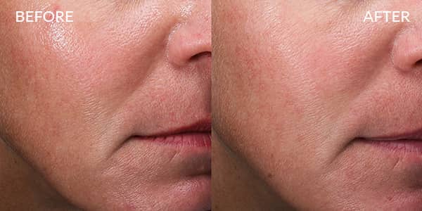 Potenza RF Microneedling for Wrinkles