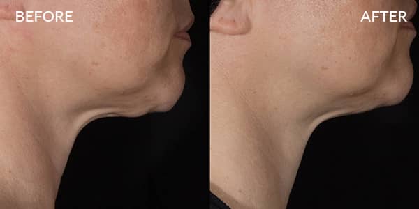 Potenza RF Microneedling for Wrinkles