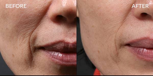 Potenza RF Microneedling for Wrinkles