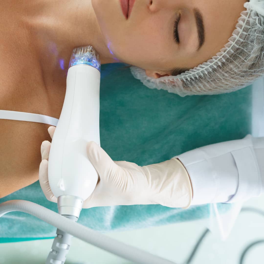 Microneedling-or-RF-Microneedling