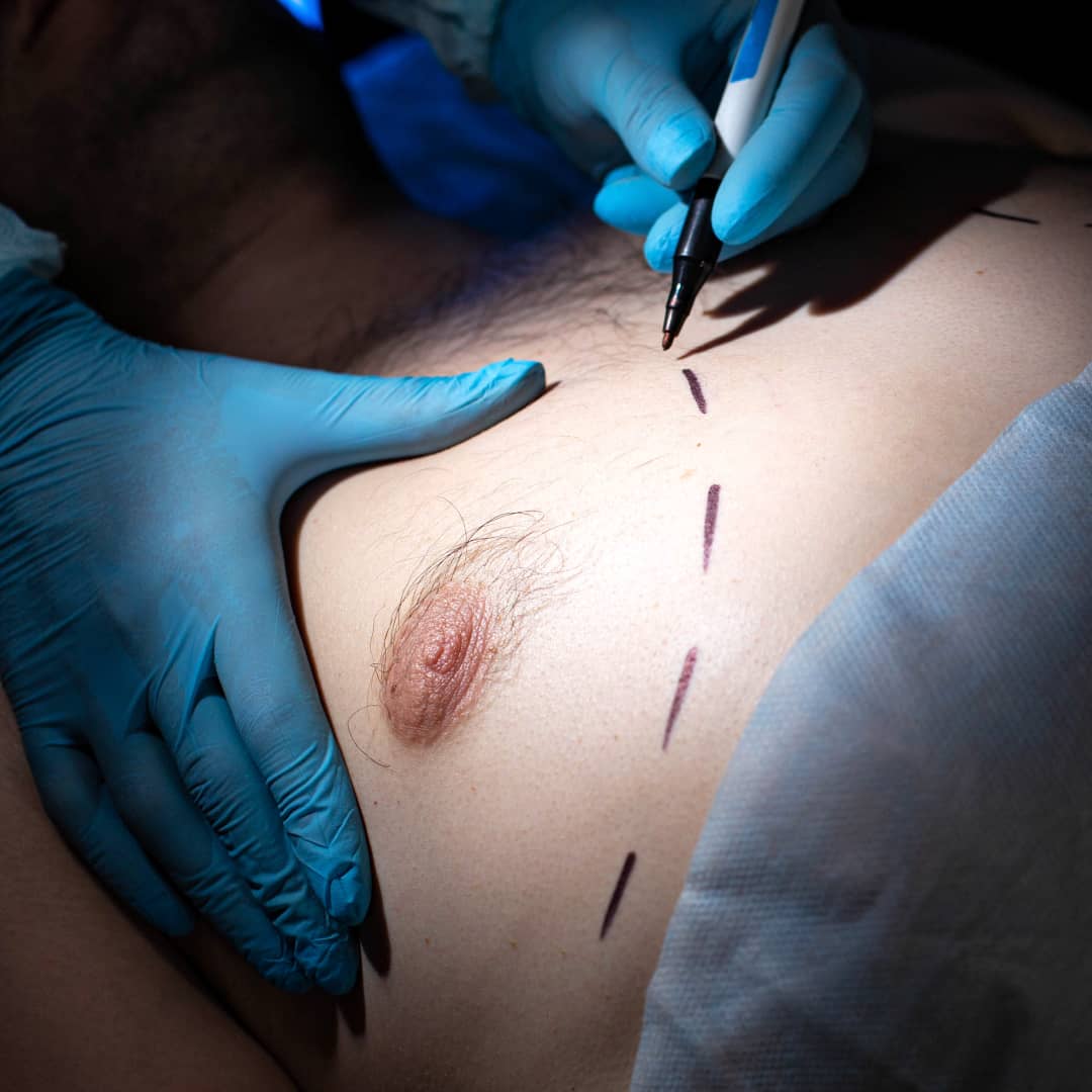 Gynaecomastia for men