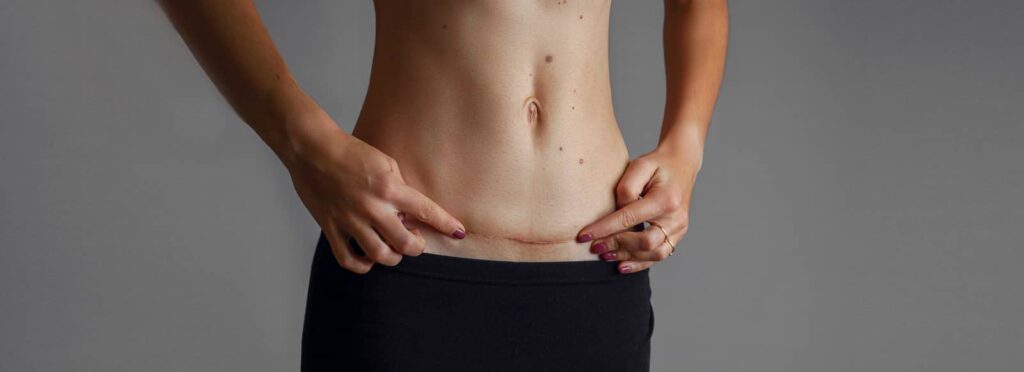 Potenza for C-Section Scars