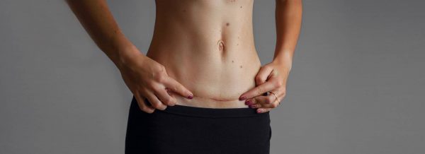 Potenza for C-Section Scars