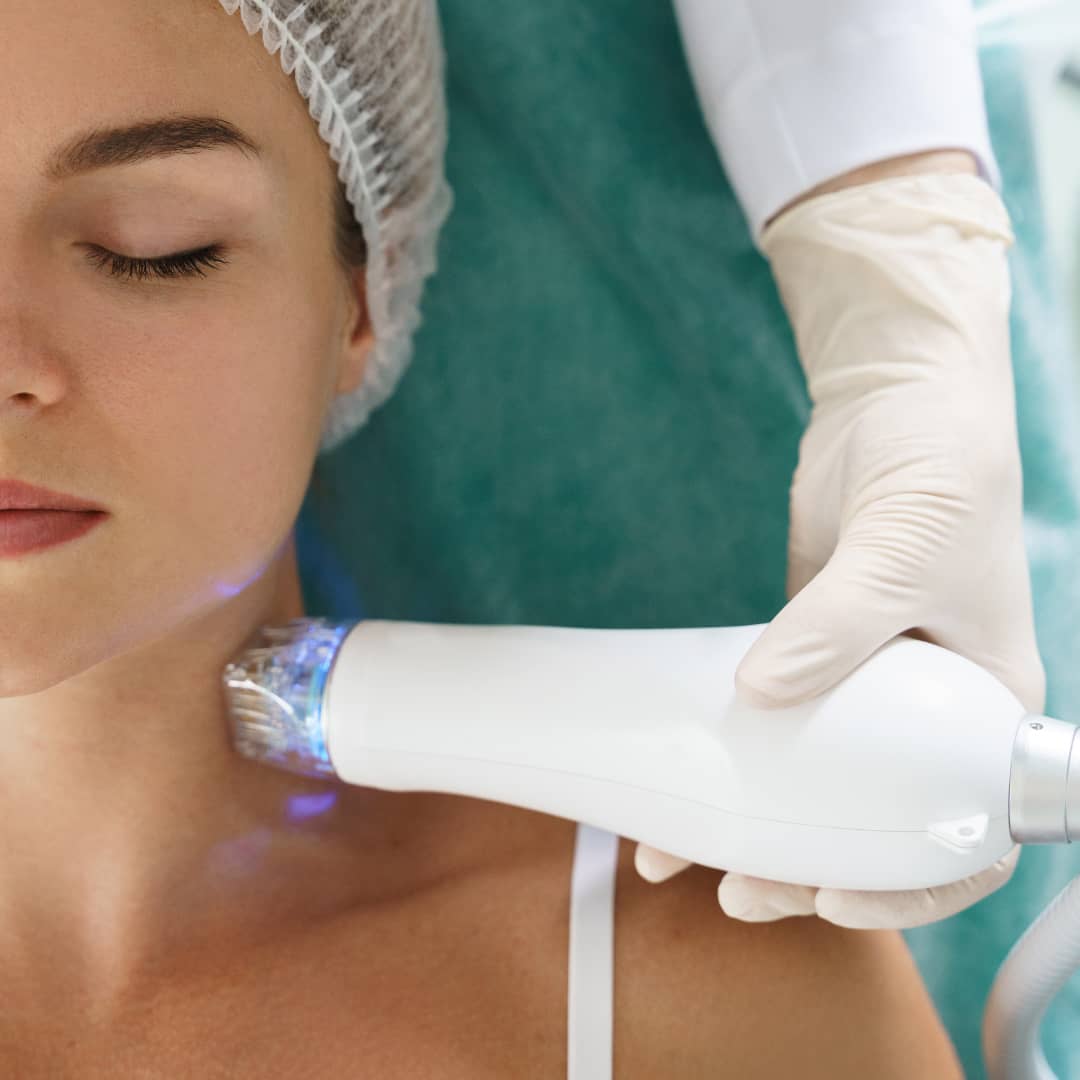 Potenza-RF-Mincroneedling-for-scars