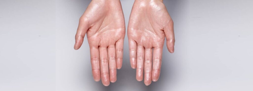 sweaty-hands