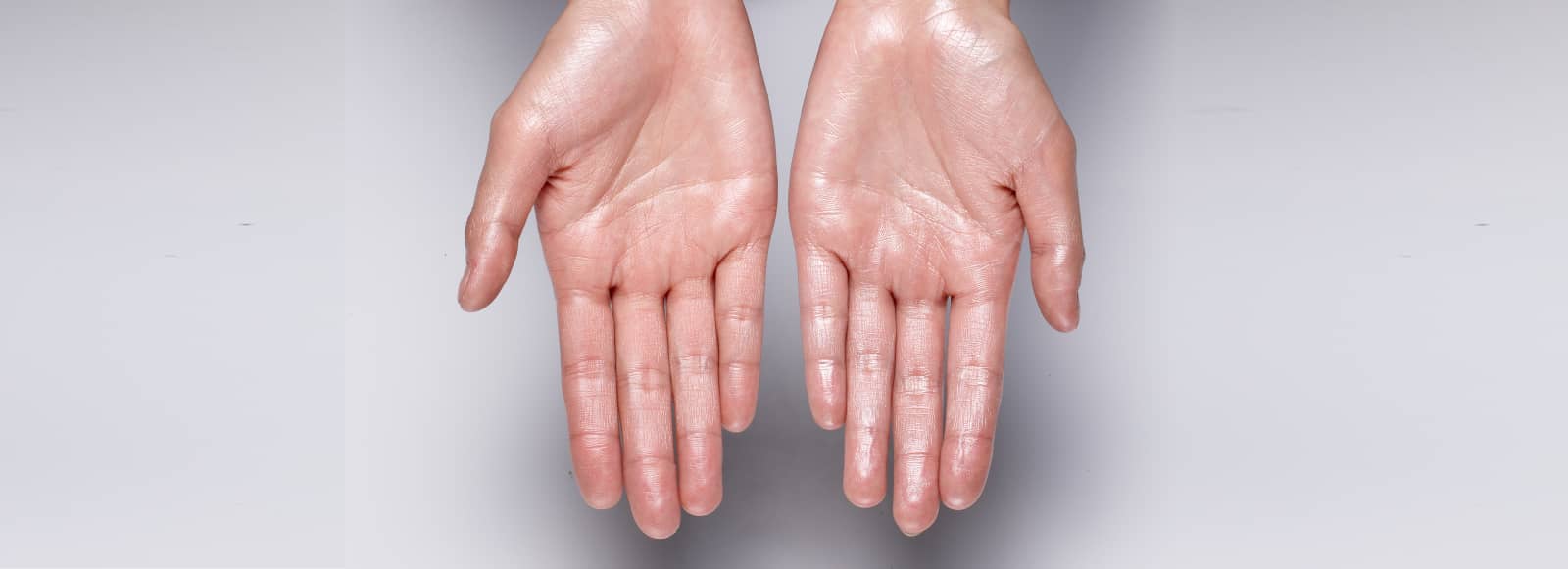 How to Treat Sweaty Hands?