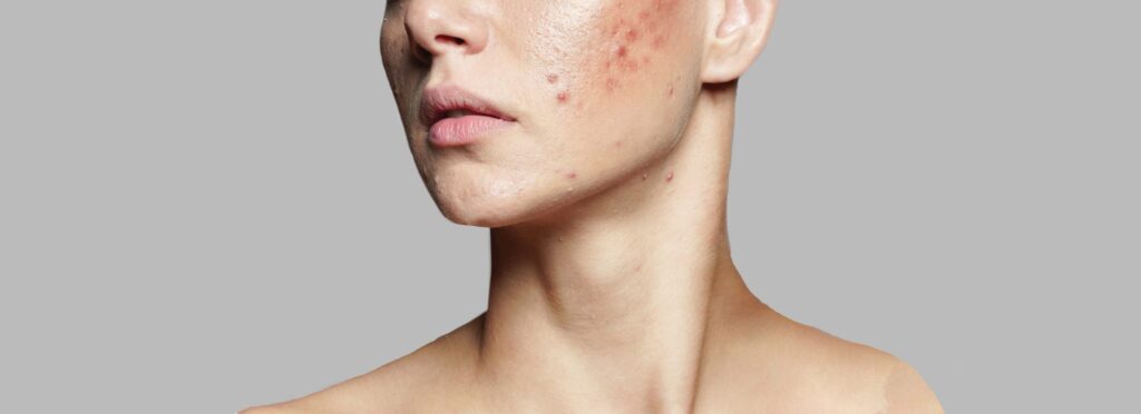 Woman with facial acne scarring