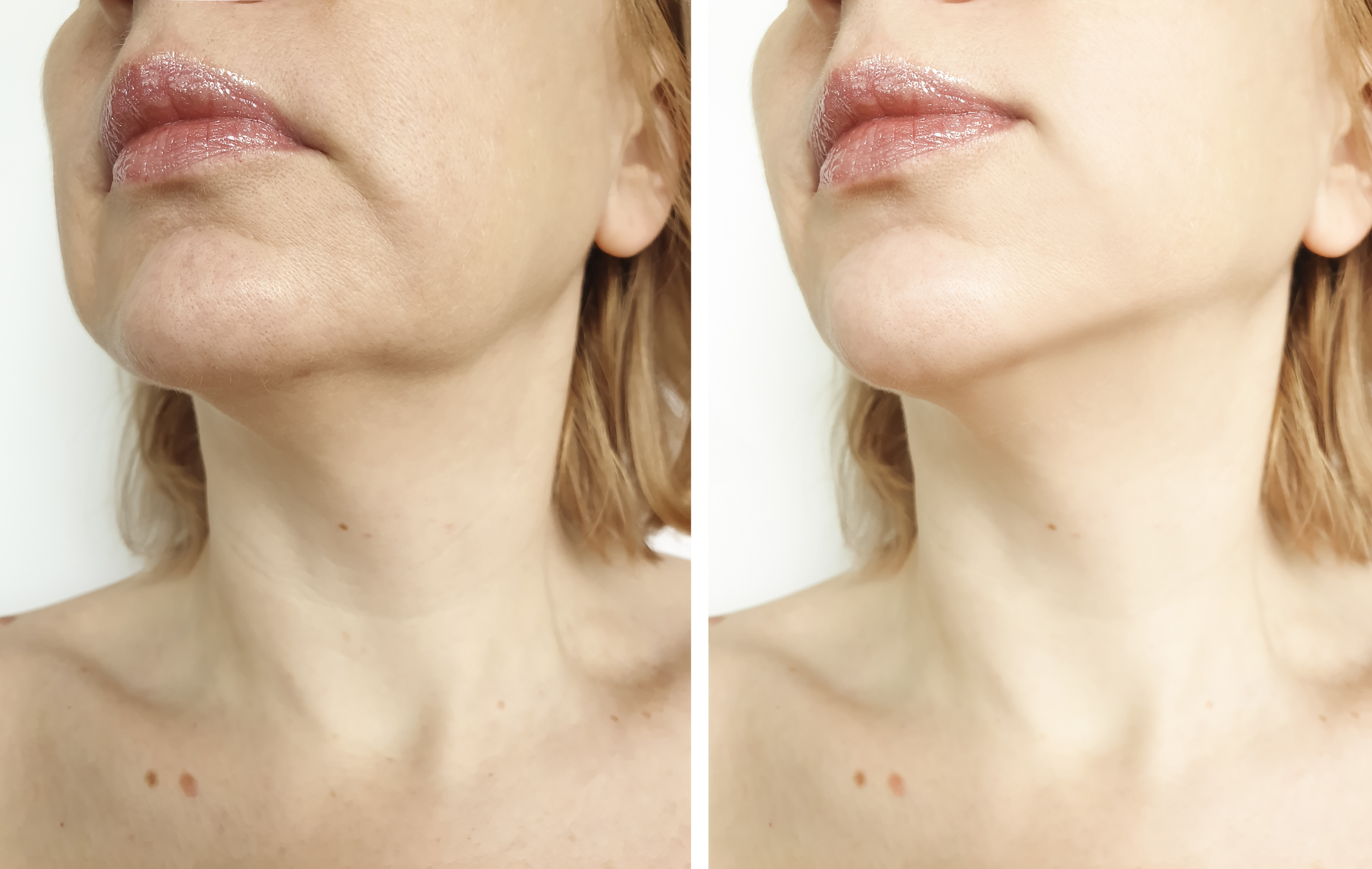 Which Jaw Reshaping Procedure Is Right For You