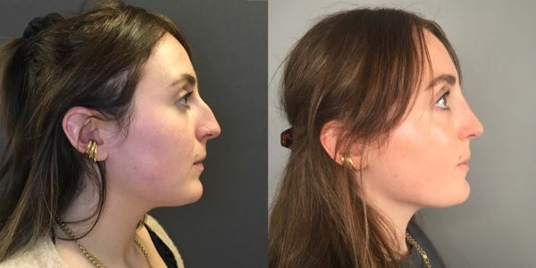 Two photos of the same woman: in the left photo her nose is hooked and in the right photo it is smooth