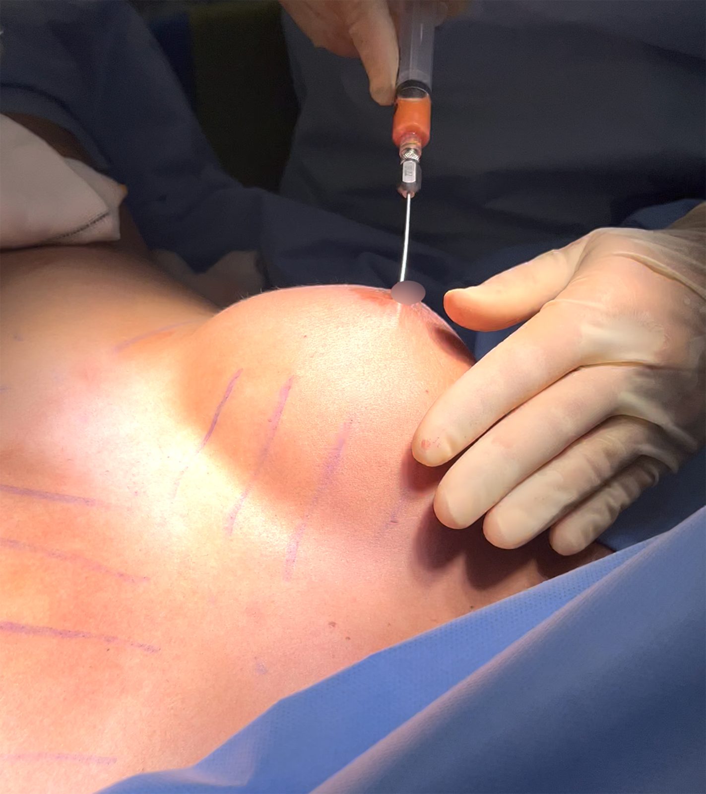 Fat Injections to The Breast