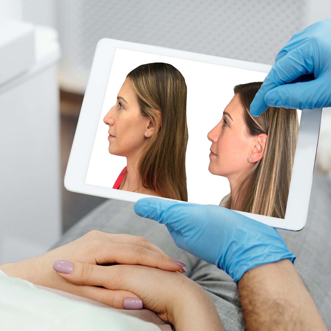 before and after nose woman