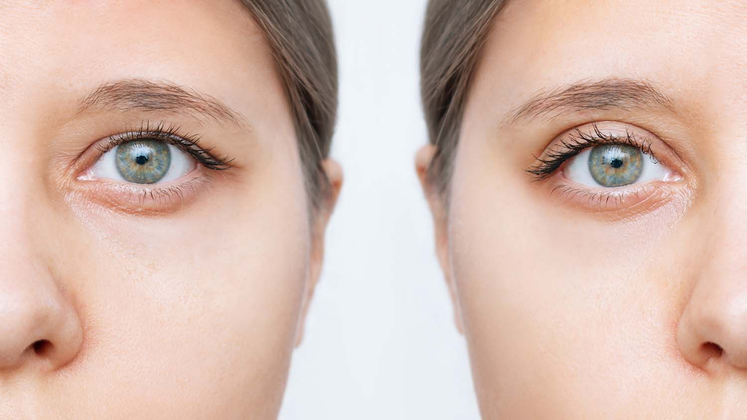 Eyelid Surgery: For Your Eyes Only