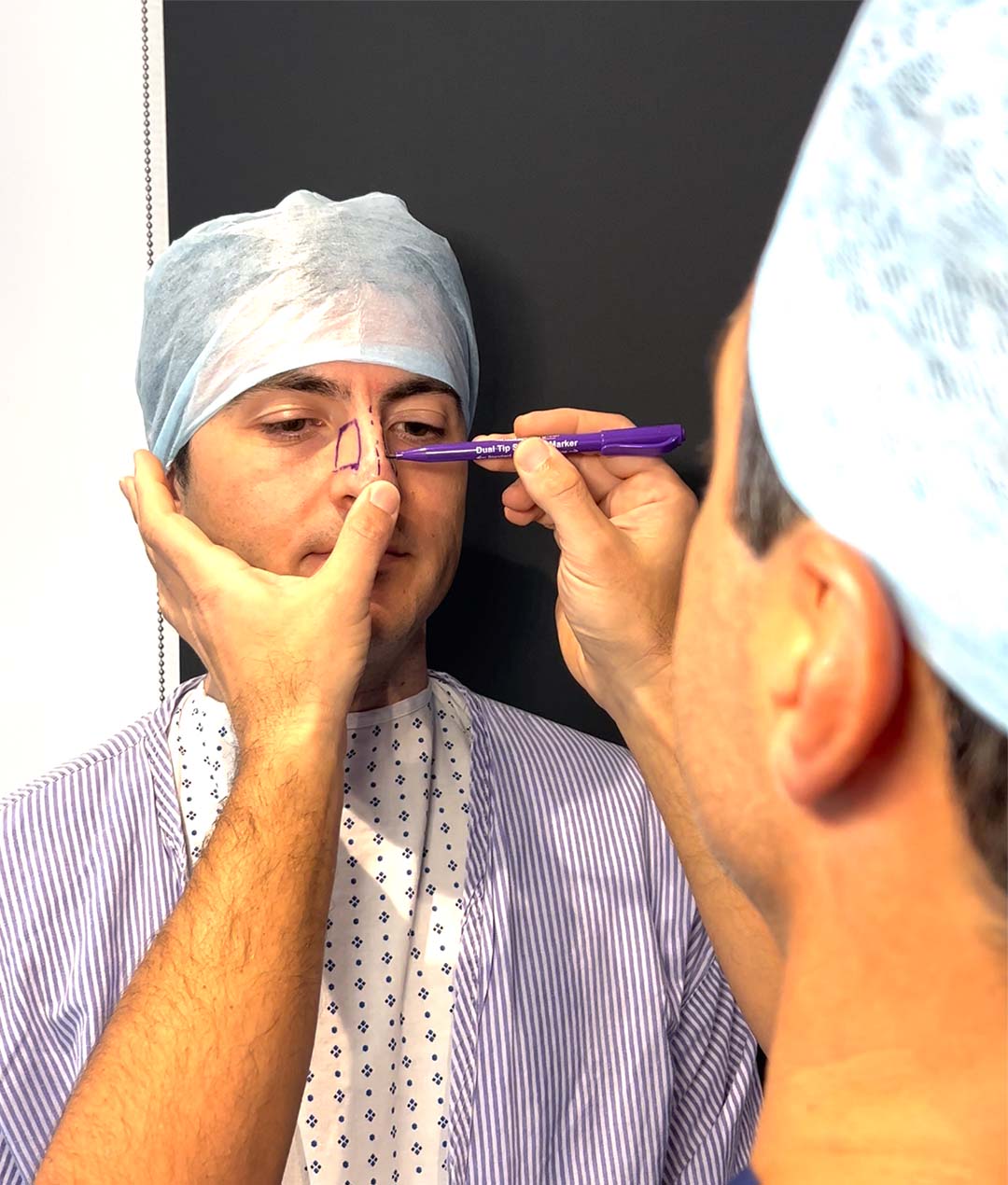 A doctor is marking a man's nose ready for Rhinoplasty surgery
