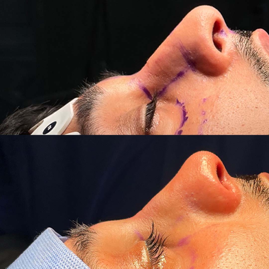 Rhinoplasty before and after