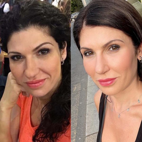 A side by side photo of a woman's nose after Rhinoplasty