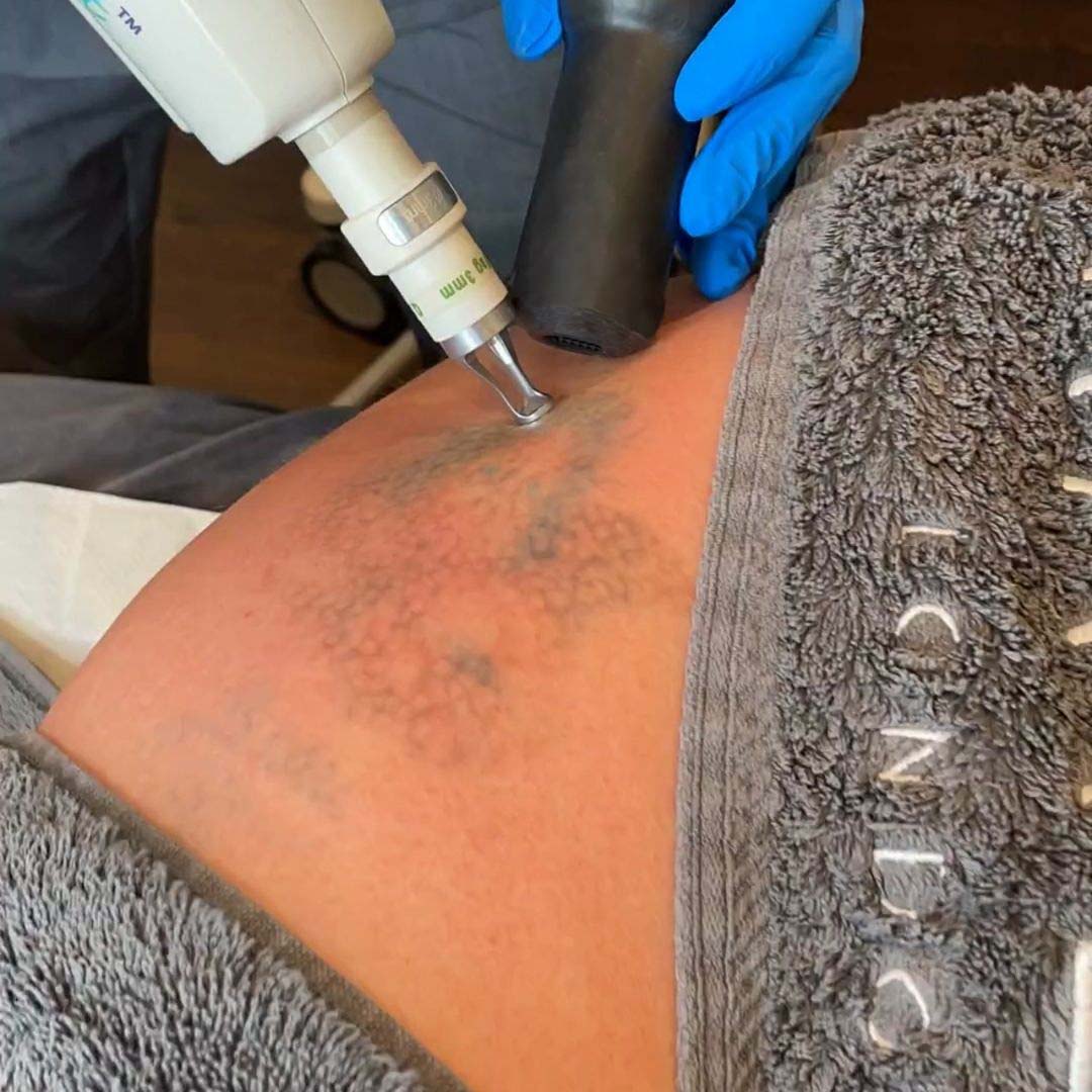 Your Guide To Tattoo Removal