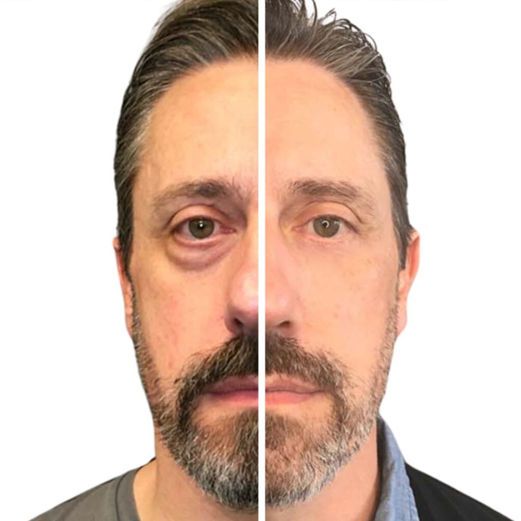 Blepharoplasty before after comparison