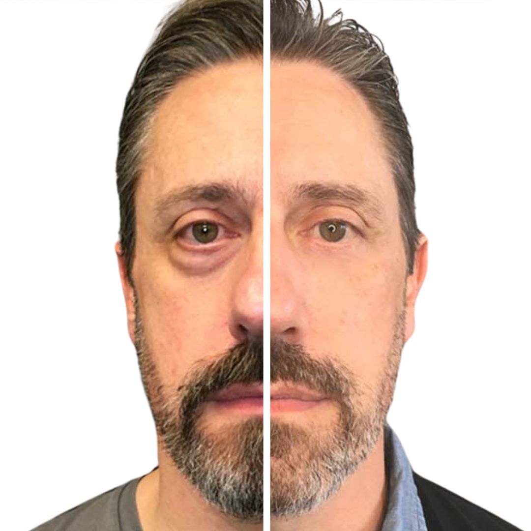 How A Blepharoplasty Can Transform Your Face
