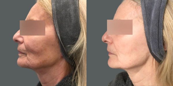 Potenza treatment before & after