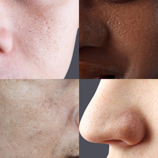 close up on nose & cheeks