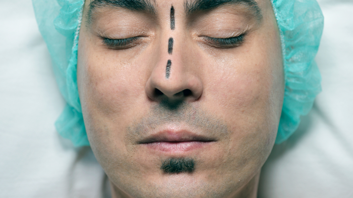 Close-up of a man’s face with surgical lines on his nose before a deviated septum surgery