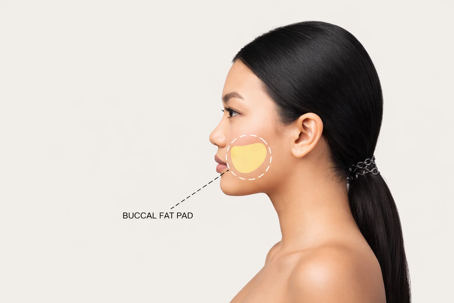 image of the location of buccal fat pads in the cheeks