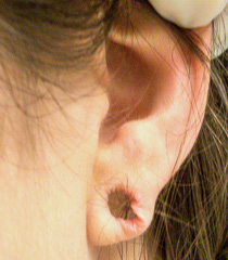ear lope before surgery