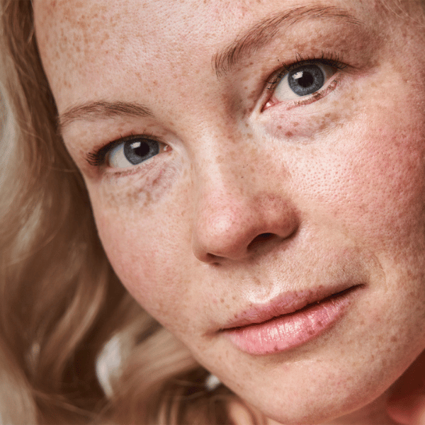 Dermal Fillers