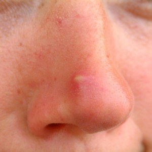 spot swelling