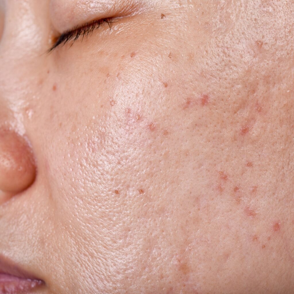 Acne scarring