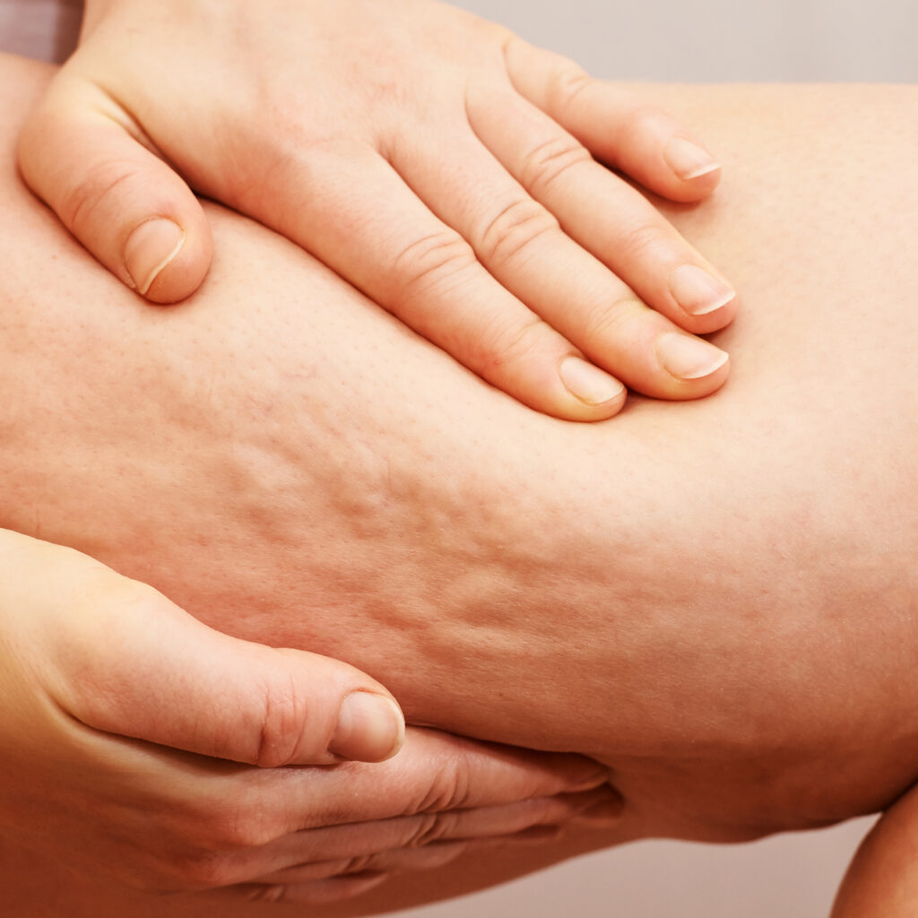 Cellulite leg woman pinch. Test fat hips treatment. Over weight liposuction. Remove striae.