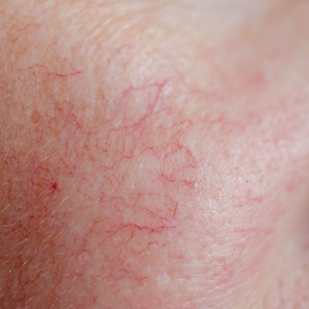 Facial Veins
