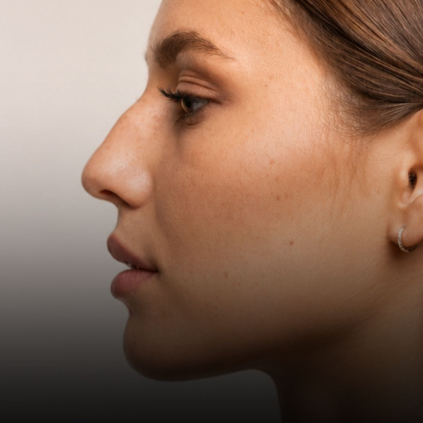 Rhinoplasty from the left