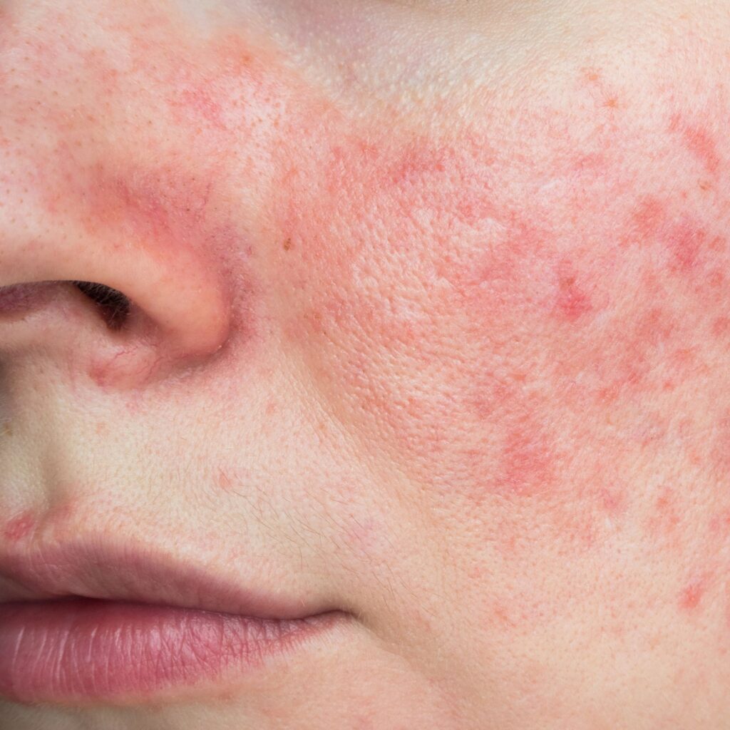 Rosacea