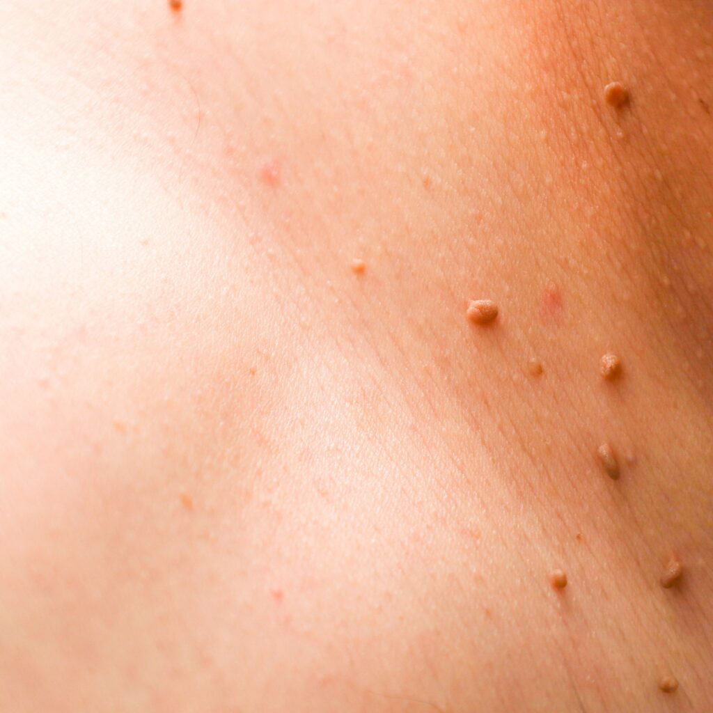 Skin Tags