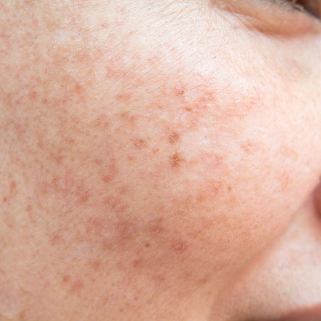 Sun Damage